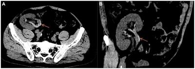 Case report: Application of nonsurgical method in saving transplant renal vein thrombosis caused by acute diarrhea